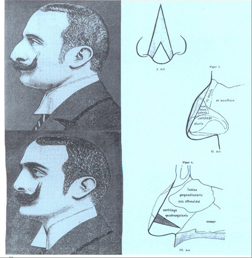 Jacques Joseph (1865-1934). Ein Streifzug durch die Geschichte der Schönheitschirurgie 
